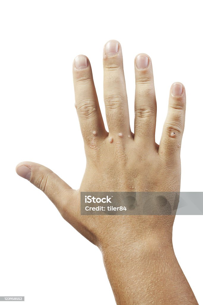 Hand with warts on white background hand with warts isolated on white background Wart Stock Photo