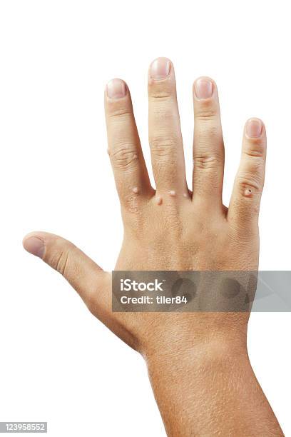 Hand With Warts On White Background Stock Photo - Download Image Now - Wart, Color Image, Cut Out