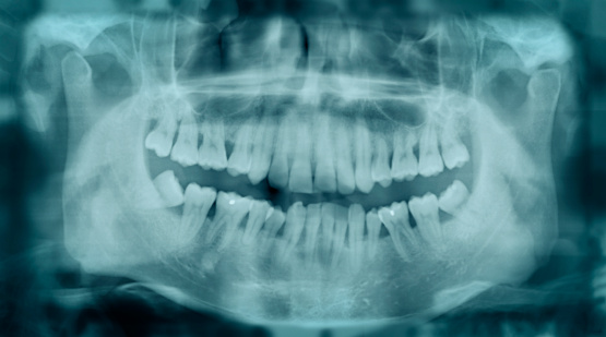 Crooked dientes de rayos X photo