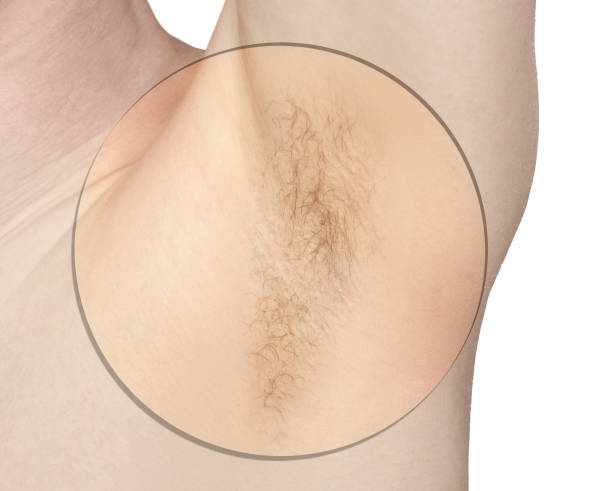 istock Girl underarm. White man armpit. Before and after epilation. 1239738317