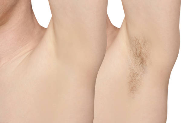 istock Girl underarm. White man armpit. Before and after epilation. 1239738364