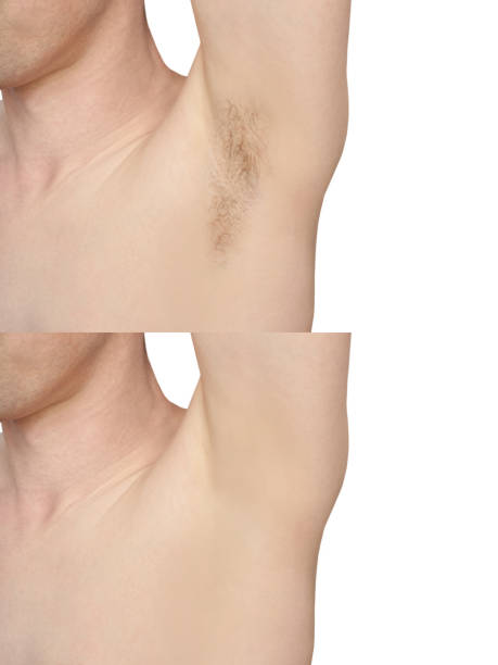 istock Girl underarm. White man armpit. Before and after epilation. 1239738744