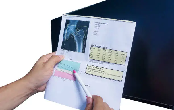 Photo of (BMD) DEXA densitometry hip scan. Osteopenia present, frequent precursor to osteoporosis on pen point on white background.Medical healthcare concept.