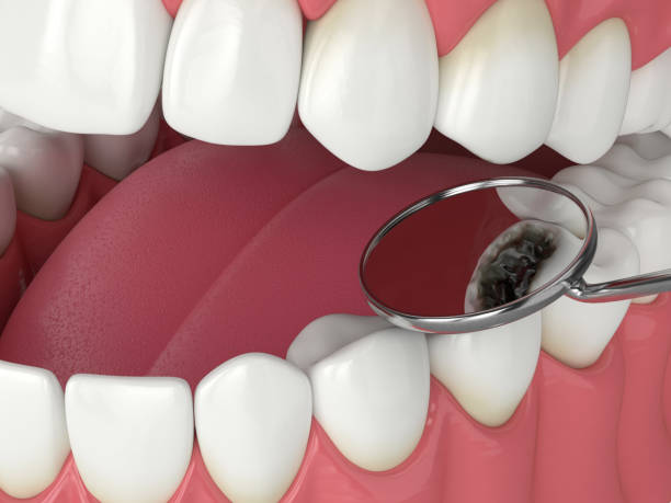 istock 3d render of jaw with dental mirror 1239799236