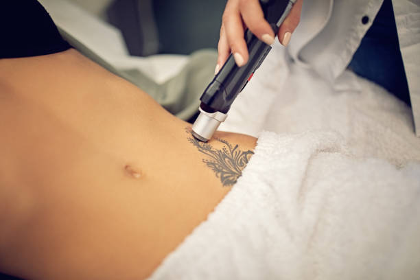 Young woman on laser tattoo removal procedure Young woman on laser tattoo removal procedure taking off activity stock pictures, royalty-free photos & images