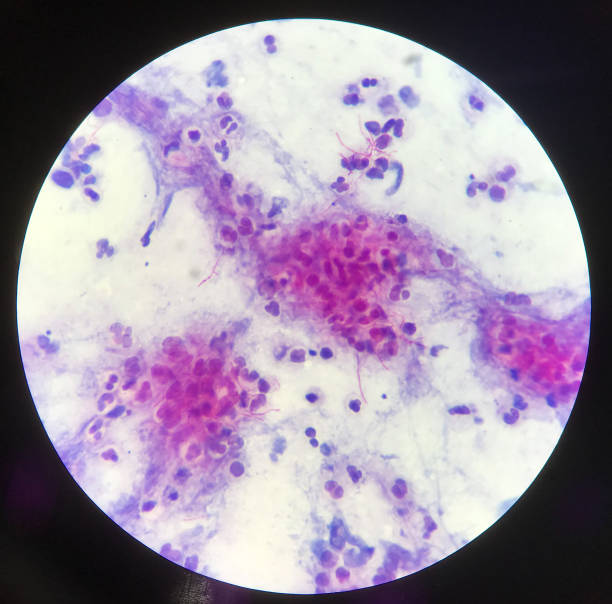 istock Red branching mycobacterium tuberculosis on blue background in modified acid fast bacilli stain.finding with microscope laboratory background. 1241033454