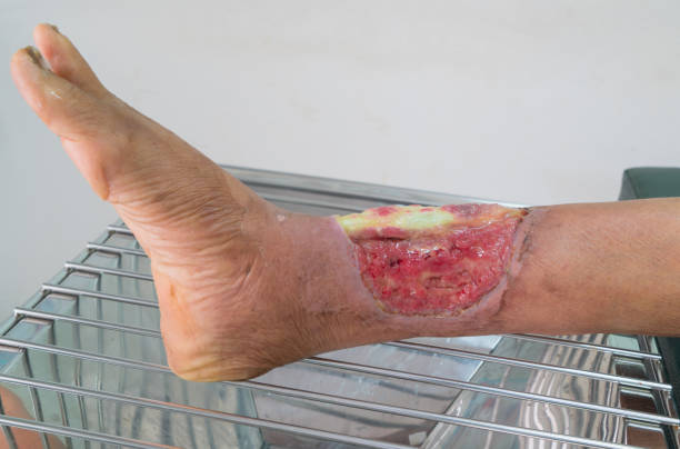 close up of a senior leg with infected wound from accident. medical concept. - wound blood human finger human hand imagens e fotografias de stock