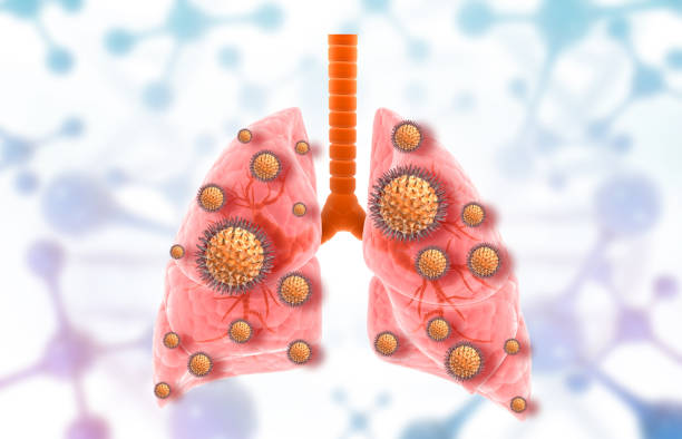 istock Virus infection in Human lungs 1243156554