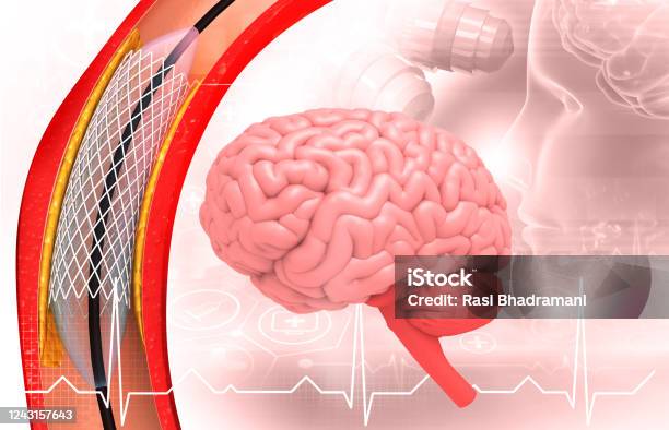 Stent Implant In Human Brain Stock Photo - Download Image Now - Stent, Cholesterol, Neurosurgery