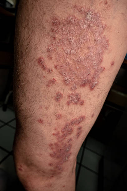 istock Psoriasis is a Chronic, inflammatory autoinmune skin disease 1244205340