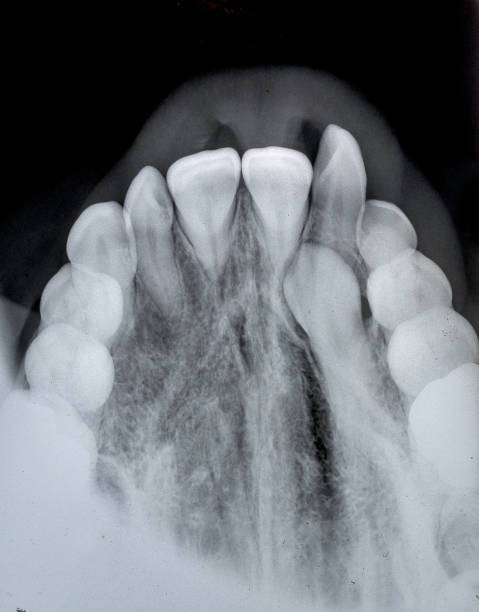 istock Impacted maxillary cuspid tooth still in the palate and unable to erupt. 1244265101
