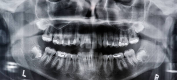 A wisdom tooth, in humans, is the usual four third molars. Most adults have four wisdom teeth. Panaramic x-ray film of developing third molar teeth with no root formed as yet. una muela del juicio, en los seres humanos, son los cuatro molares habituales. la mayoría de los adultos tienen cuatro muelas del juicio. película de rayos x panámica de desarrollo de tercer diente molar sin raíz formada hasta el momento.