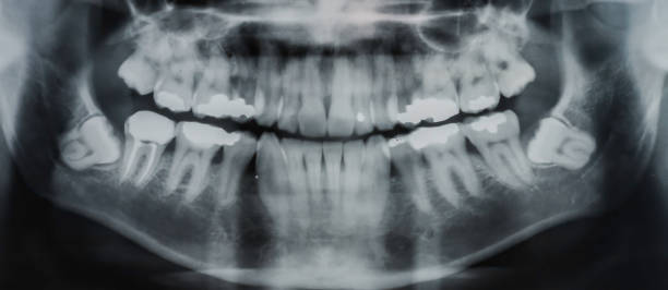A wisdom tooth, in humans, is any of the usual four third molars. Wisdom teeth can develop, becoming impacted or "coming in sideways. Deeply impacted third morlar teeth or windom teeth. A wisdom tooth, in humans, is any of the usual four third molars. Wisdom teeth can develop, becoming impacted or "coming in sideways. Deeply impacted third morlar teeth or windom teeth. skull photos stock pictures, royalty-free photos & images