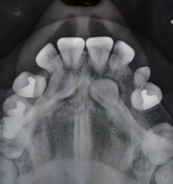 Impacted maxillary cuspid teeth still in the palate and unable to erupt.