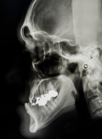 Progenija Pathologic Mandibular Prognathism Is A Potentially Disfiguring Genetic ...
