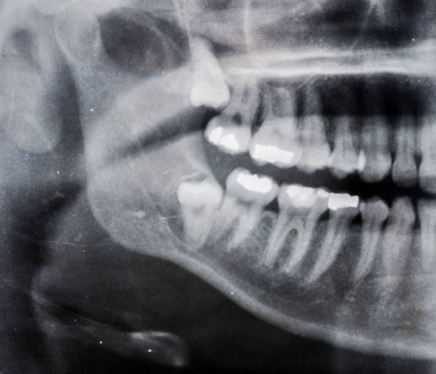 A wisdom tooth, in humans, is any of the usual four third molars. Wisdom teeth can develop, becoming impacted or \