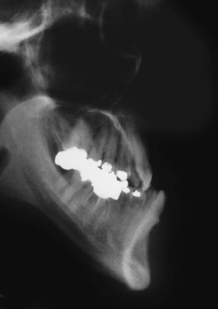 istock Pathologic mandibular prognathism is a potentially disfiguring genetic disorder where the lower jaw outgrows the upper, resulting in an extended chin. 1244266167