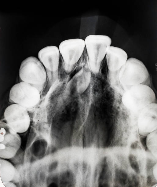 istock Hyperdontia is the condition of having supernumerary teeth, or teeth which appear in addition to the regular number of teeth. Supernumerary tooth in the palate close to the midline. 1244266170