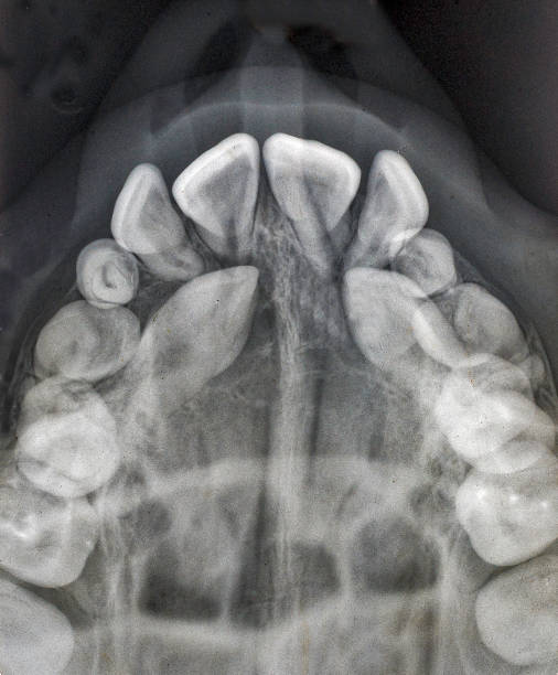 istock Impacted maxillary cuspid teeth still in the palate and unable to erupt. 1244266177