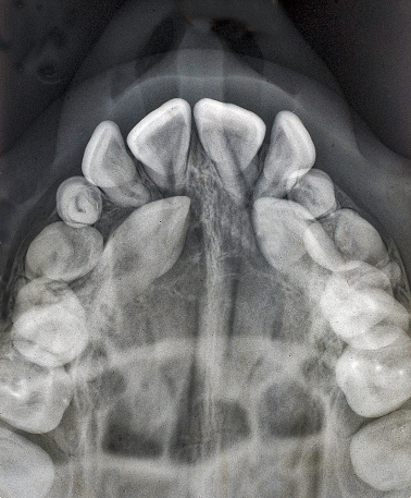Impacted maxillary cuspid teeth still in the palate and unable to erupt.