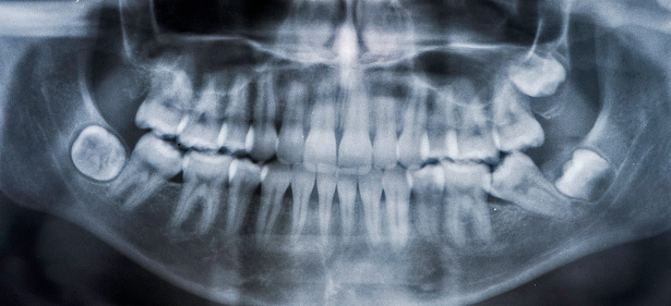 A wisdom tooth, in humans, is any of the usual four third molars. Wisdom teeth can develop, becoming impacted or \