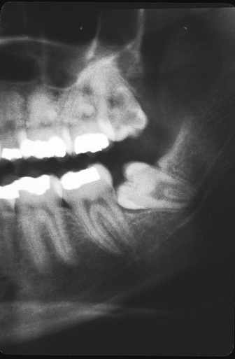 Metal braces over teeth. Medically accurate 3D illustration