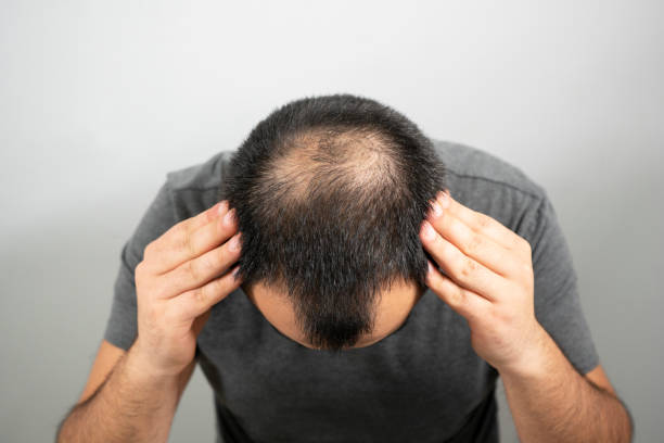sparse hair and bald head problem on a grey background - hair loss imagens e fotografias de stock