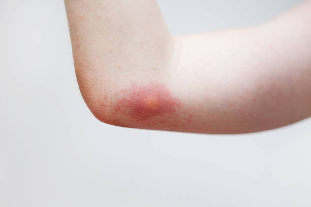 Wasp Sting Allergy on the skin after the wasp sting. stinging stock pictures, royalty-free photos & images