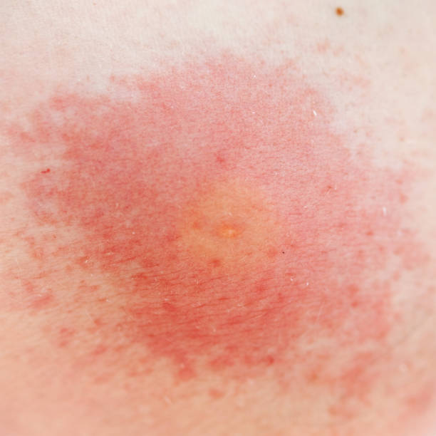 Wasp Sting Allergy Allergy on the skin after the wasp sting. red wasp stock pictures, royalty-free photos & images