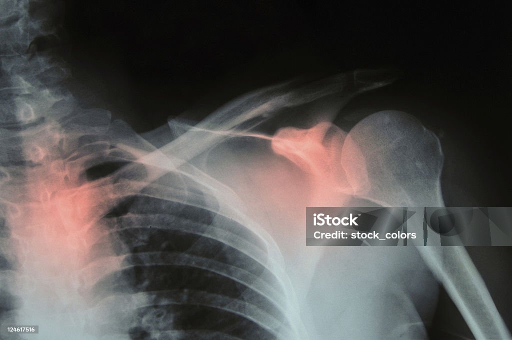 pain xray shot, red spot  was alocated for pain or other problemshttp://gallery.photo.net/photo/12551815-lg.jpg Osteoporosis Stock Photo