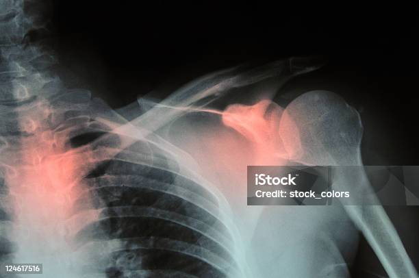 Pain Stock Photo - Download Image Now - Osteoporosis, Anatomy, Arthritis