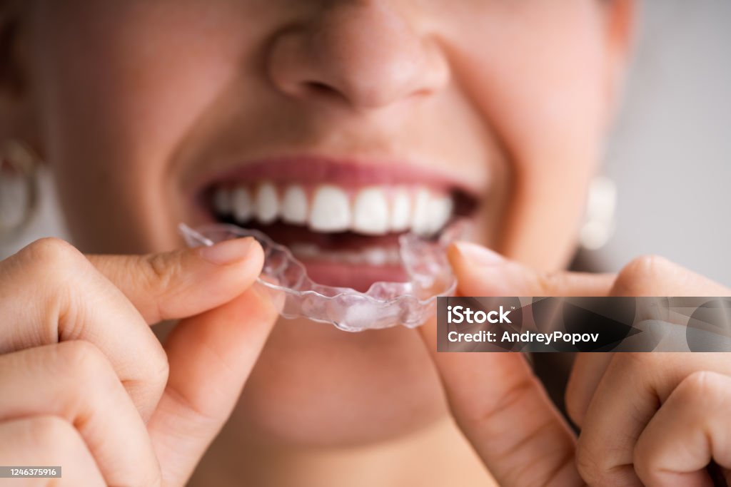 Clear Aligner Dental Nachtwache - Lizenzfrei Zahnschiene Stock-Foto