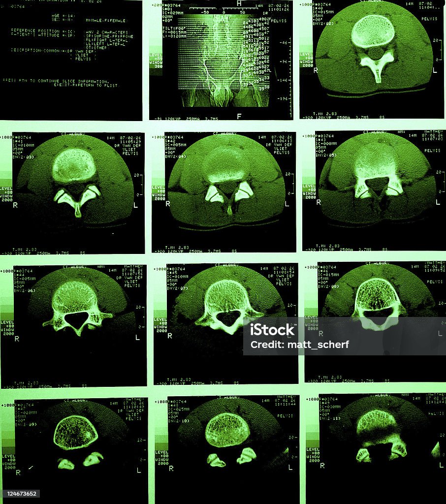 La tomografía computarizada de la Pelvis Grunge de matriz - Foto de stock de Tomografía axial computerizada libre de derechos