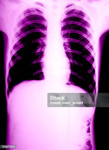 Photo libre de droit de Xray Grungeviolet La Poitrine banque d'images et plus d'images libres de droit de Abstrait - Abstrait, Blessure physique, Cage thoracique