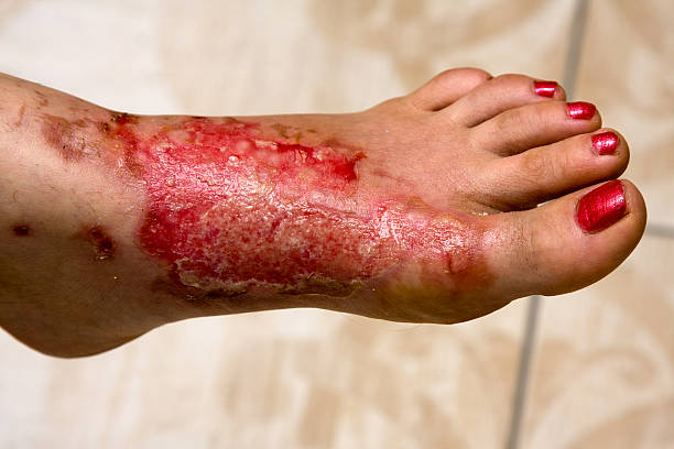 A woman's foot covered in severe burns stock photo