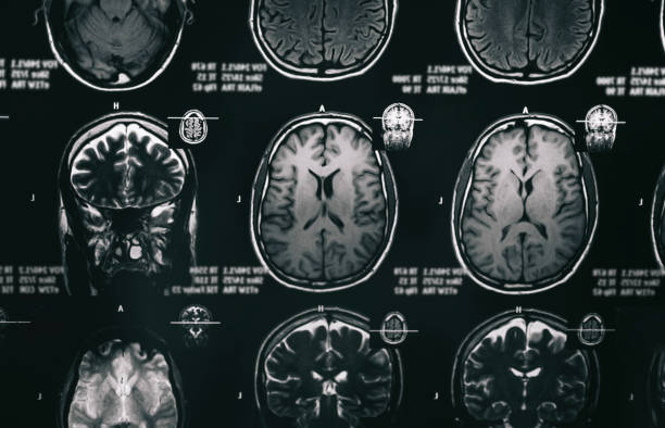istock MRI scan of human brain 1246964905
