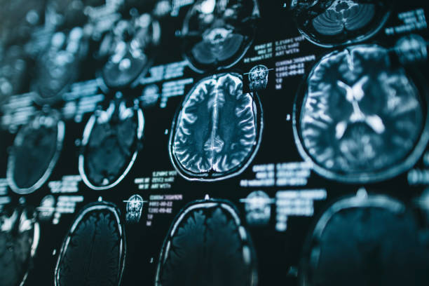 магнитно-резонансная томография головного мозга - brain mri scan alzheimers disease medical scan стоковые фото и изображения