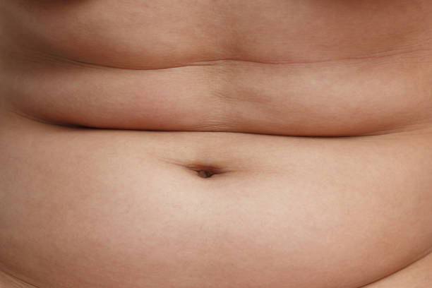 istock closeup of abdominal surface woman fat 1247014404