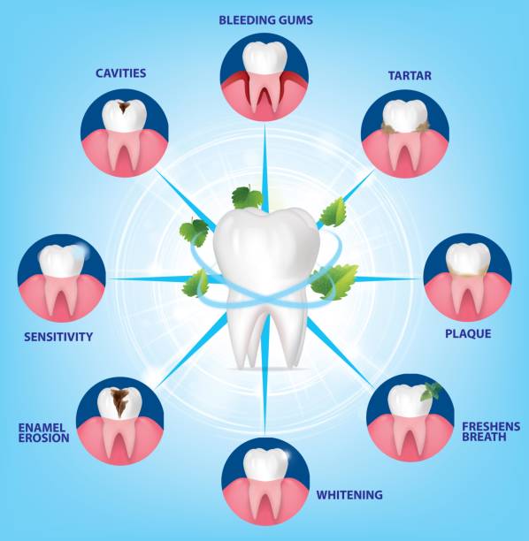 ilustrações de stock, clip art, desenhos animados e ícones de stomatological concept. the stages of gum disease, the stage of development of dental periodontitis. vector illustration. - human teeth dental hygiene anatomy diagram