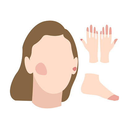 Face, hand and foot with frostbite symptoms, allergy or skin burn. Skin redness, erythema, hypothermia. Flat vector illustration, isolated on white