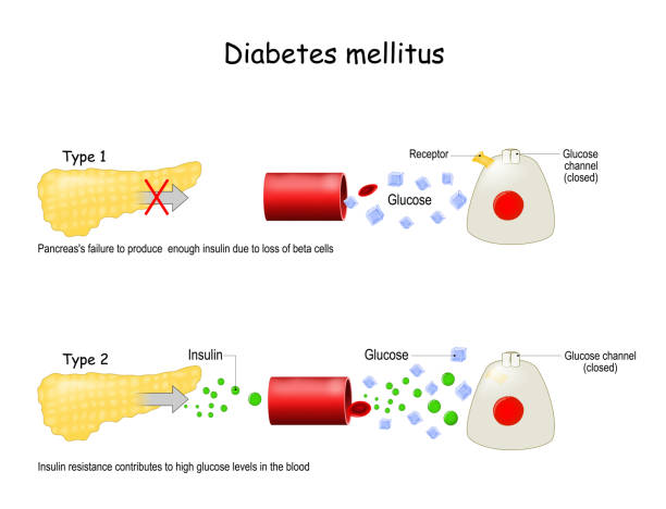 Types of diabetes mellitus Types of diabetes mellitus. Either the pancreas not producing enough insulin or the cells of the body not responding properly to the insulin produced. Comparison of cell work in diabetes. Insulin resistance contributes to high glucose levels in the blood. Vector illustration. metabolism illustrations stock illustrations