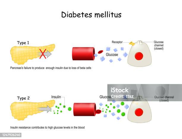 Types Of Diabetes Mellitus Stock Illustration - Download Image Now - Diabetes, Pancreas, Typing