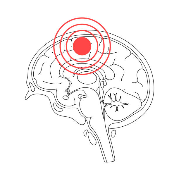 Pain Brain Illustration Vector isolated illustration of pain, inflammation or tumor in human brain components. Detailed anatomy. Medical infographics for poster. Sagittal view of the brain midbrain illustrations stock illustrations