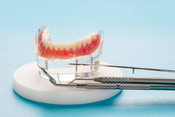 istock Teeth model showing an implant crown bridge model. 1248070940