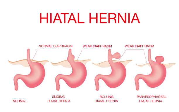 Hiatal hernia. Hiatal hernia and normal anatomy of the stomach Hiatal hernia. Vector diagram of Normal anatomy and sliding hiatal hernia. sphincter stock illustrations