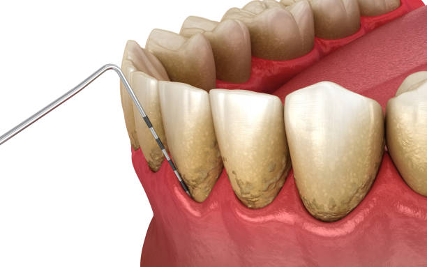 istock Periodontitis testing, gum recession process. Medically accurate 3D illustration 1248129266