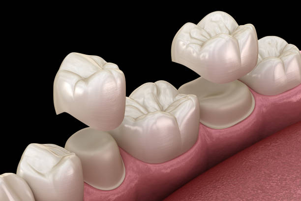 istock Porcelain crowns placement over premolar and molar teeth. . Medically accurate 3D illustration 1248129298