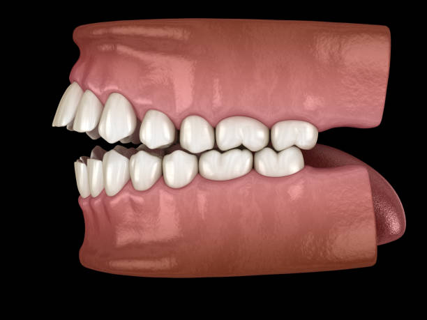 openbite zahnverschluss ( maloklusion der zähne ). medizinisch genaue zahn-3d-illustration - fehlbiss stock-fotos und bilder