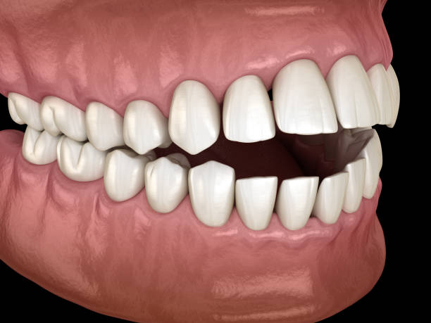 istock Openbite dental occlusion ( Malocclusion of teeth ). Medically accurate tooth 3D illustration 1248129337