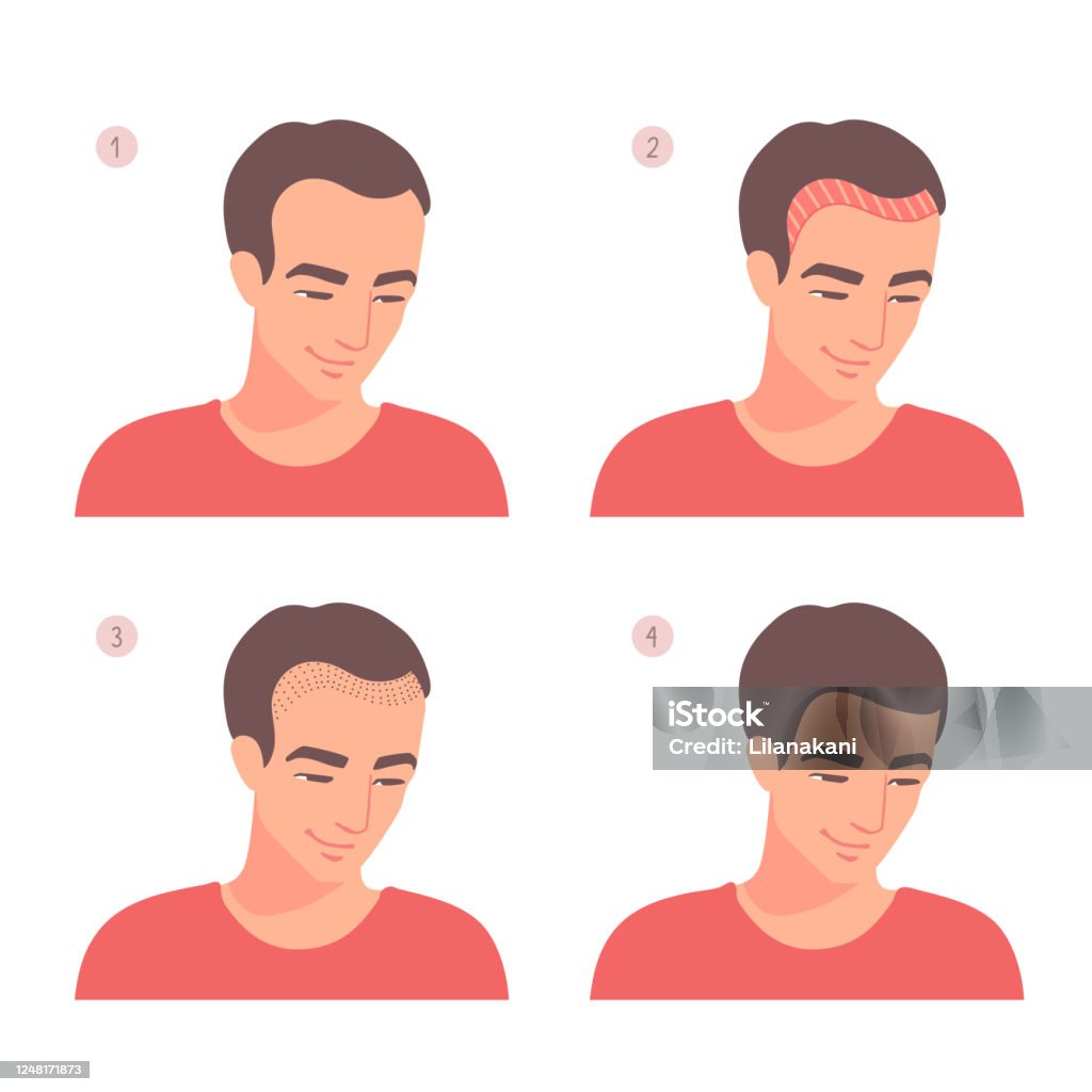 Hair Transplant Stages Of A Procedure A Forehead Hairline Receding  Treatment Lowering The Height Of A Hairline Hair Loss Stock Illustration -  Download Image Now - iStock